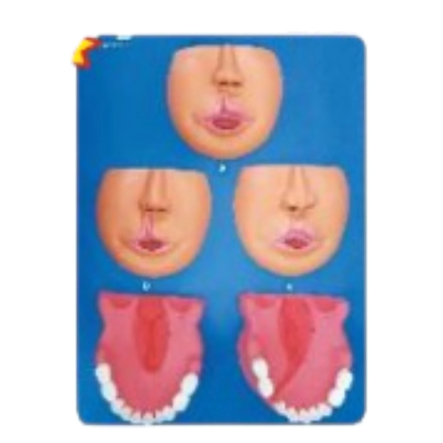 Cleft Lip & Palate