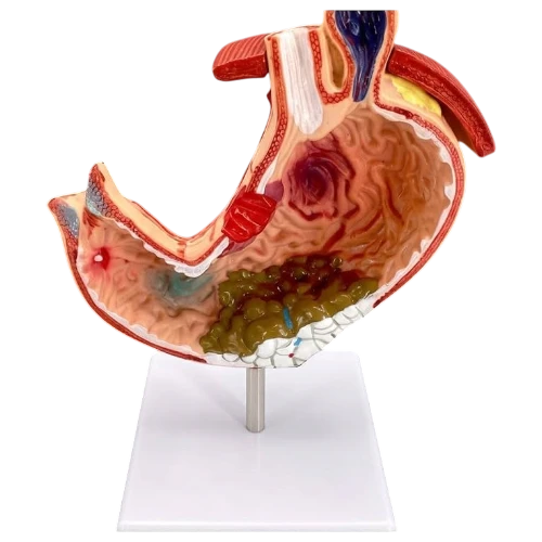 Stomach Pathology Model