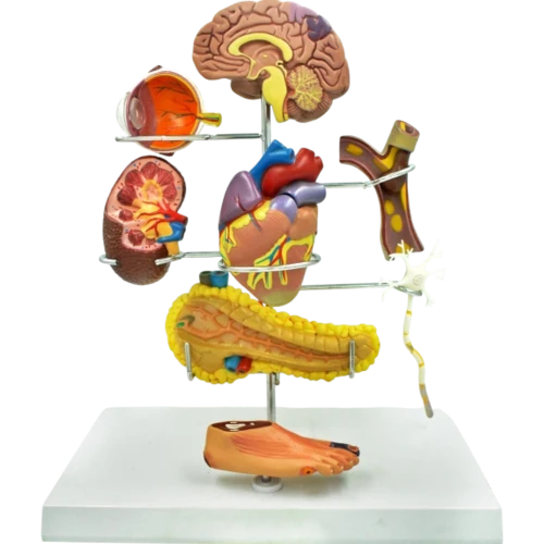 Diabetes Mellitus Complications Model