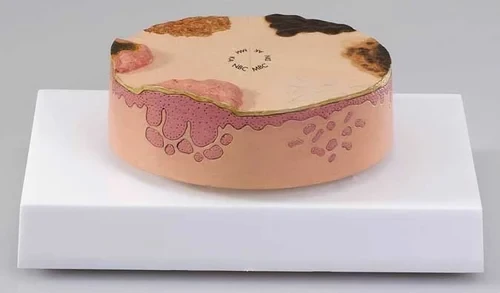 Skin Cancer